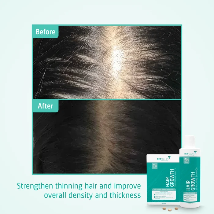 Hair Growth Thinning hair routine before after